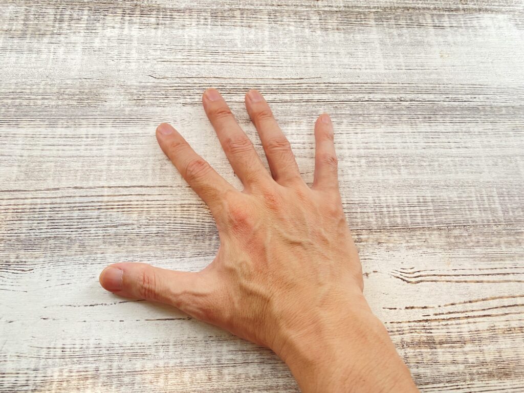 火傷温めるホメオパシー